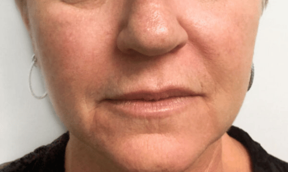 face without wrinkles