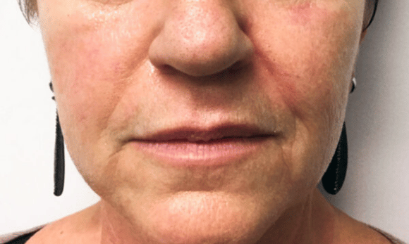 wrinkles on face