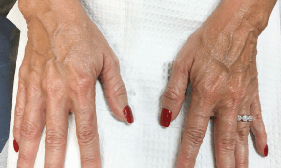 wrinkles on hands