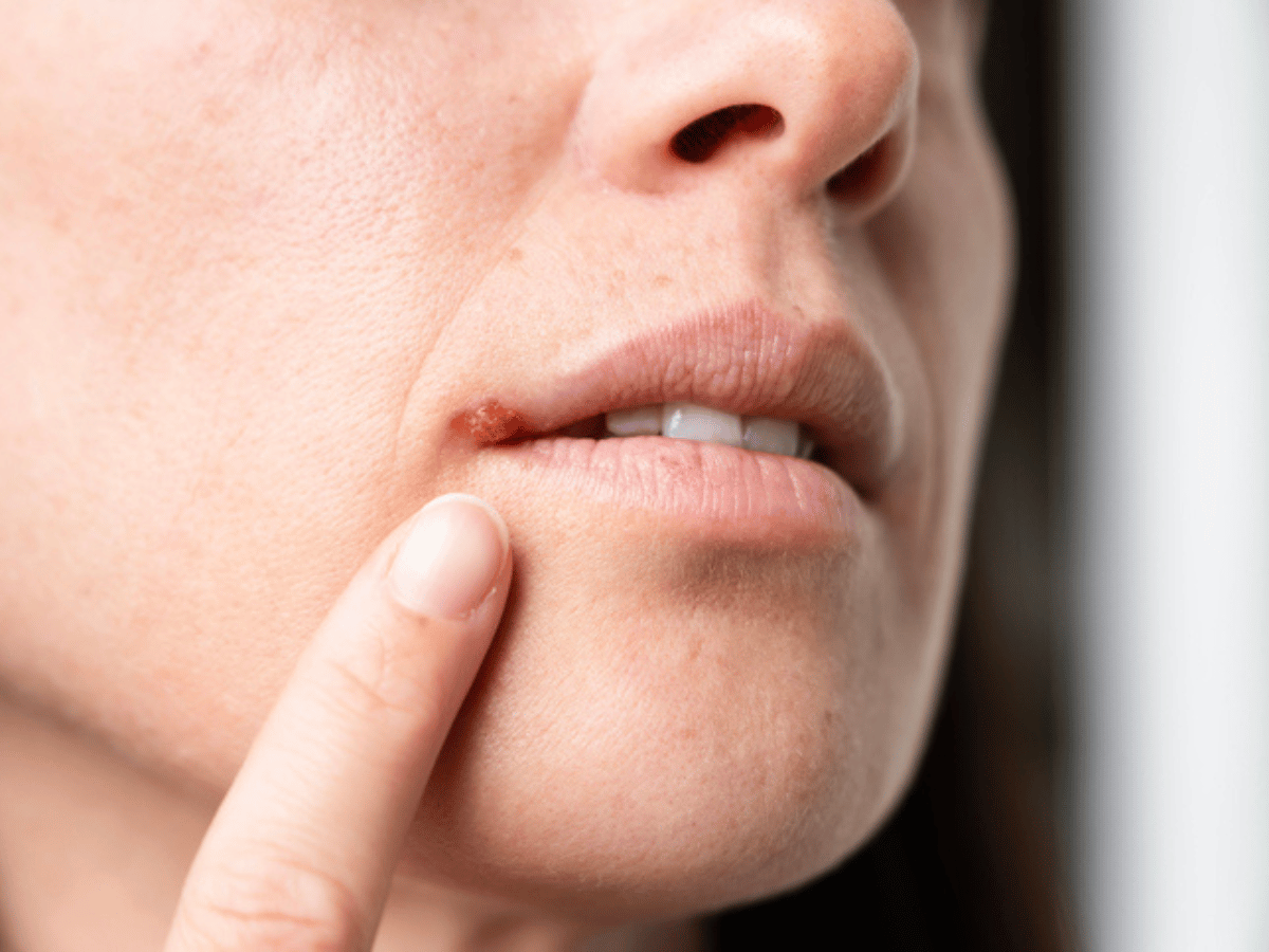 herpes on lips