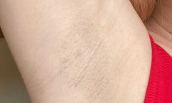 hairless armpit