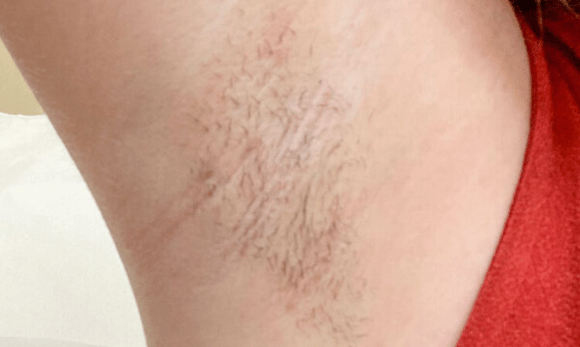 hairy armpit