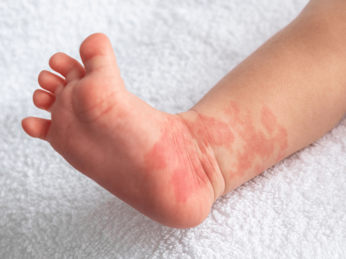 rash on children's foot