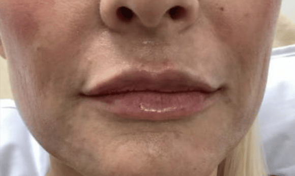 lips after rha