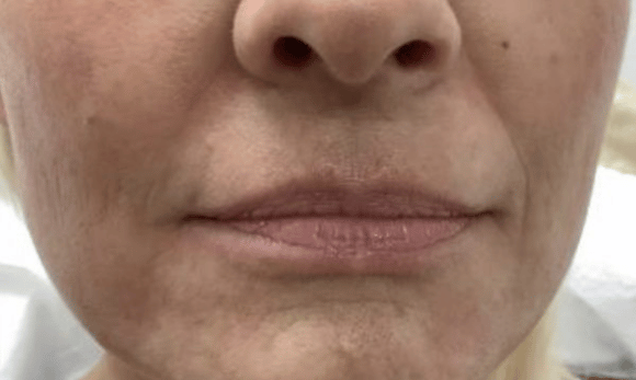 lips before rha