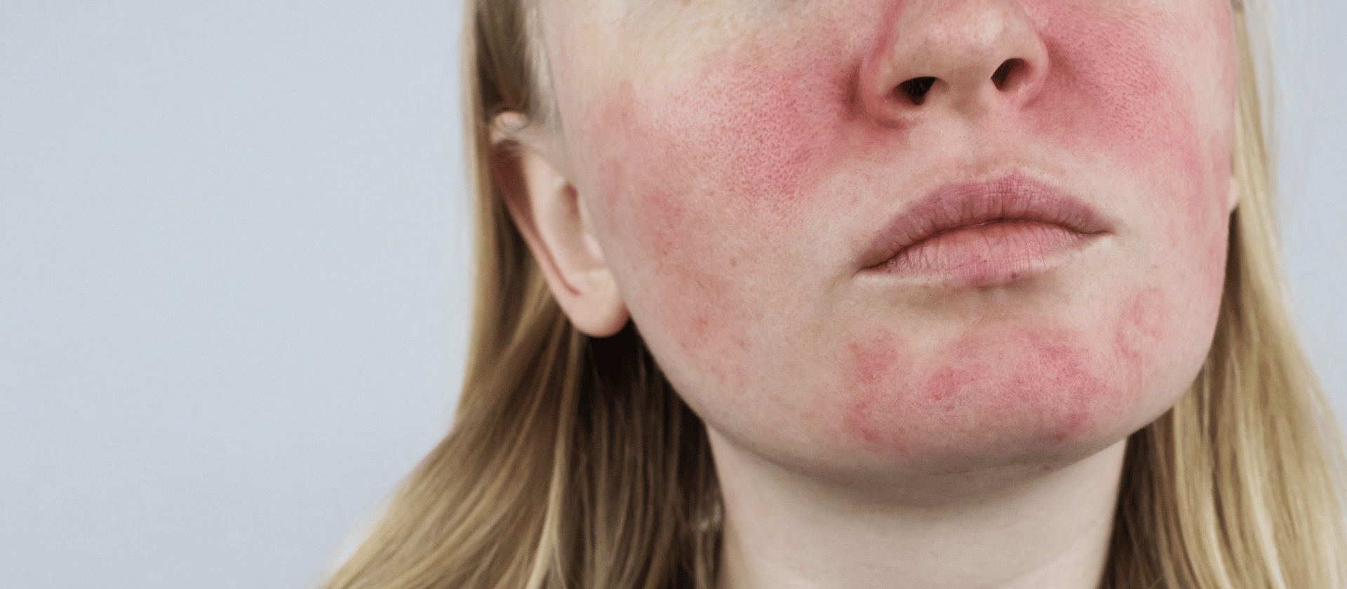 young woman's face covered in rosacea