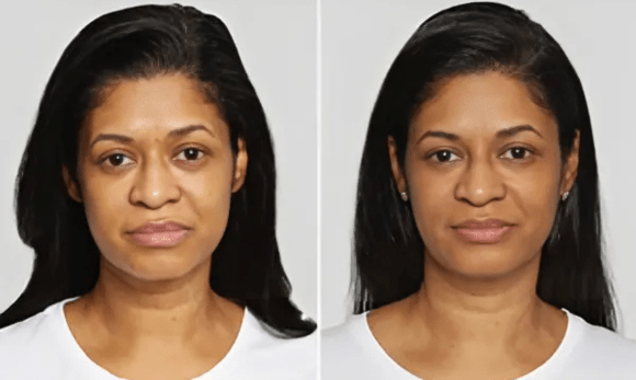 woman before and after sculptra treatment