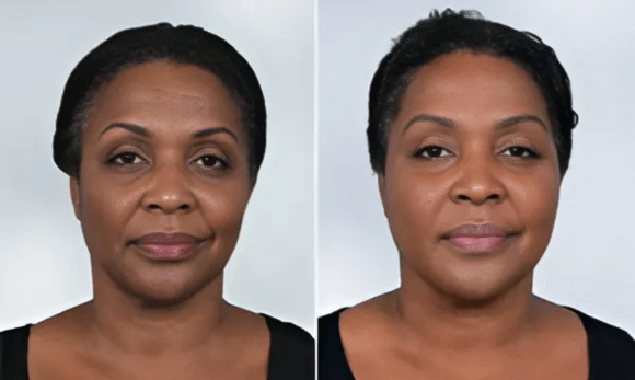 woman before and after sculptra treatment