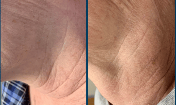 before and after microneedling