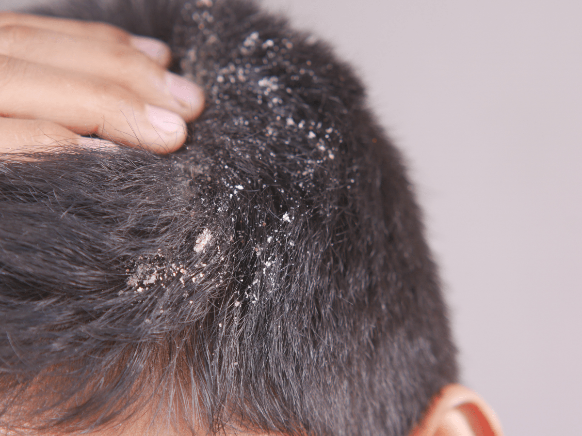 dandruff on males scalp