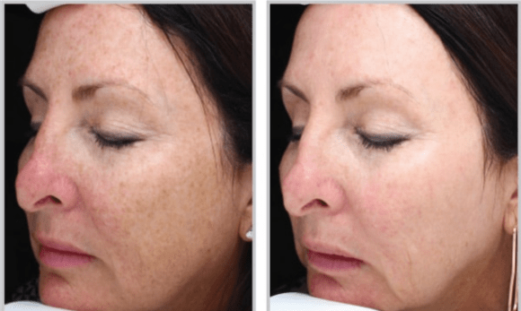 woman's face before and after halo hybrid fractional laser treatment