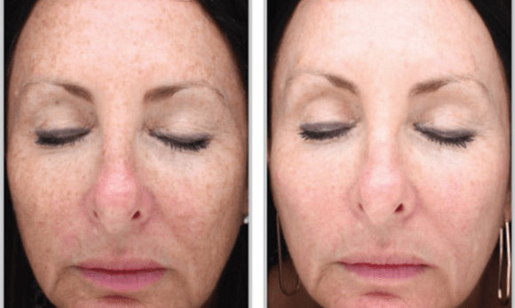 woman's face before and after halo hybrid fractional laser treatment