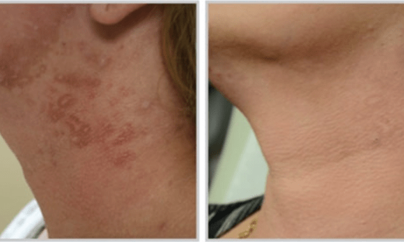 woman's neck before and after halo hybrid fractional laser treatment