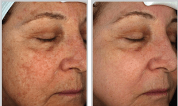 woman's face before and after halo hybrid fractional laser treatment