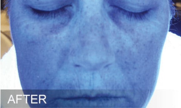 Image of woman's face after hydrafacial treatment showing improvement of skin hydration under blue light