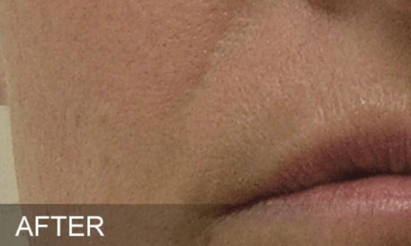 Image of woman's face after hydrafacial treatment showing improvement of nasolabial folds