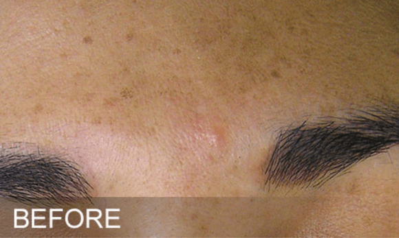 Image of woman's face before hydrafacial treatment showing brown spots on forehead