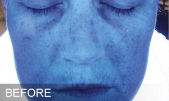 Image of woman's face before hydrafacial treatment showing dehydrated skin under blue light