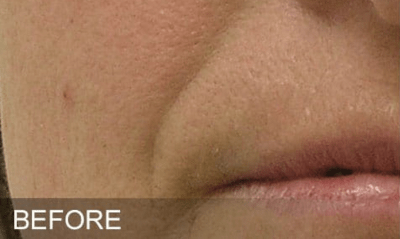 Image of woman's face before hydrafacial treatment showing nasolabial folds