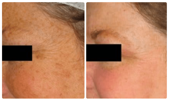 photos of woman's cheek before and after photo rejuvenation treatment
