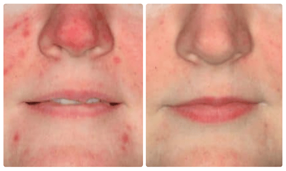 photos of woman's face before and after photo rejuvenation treatment