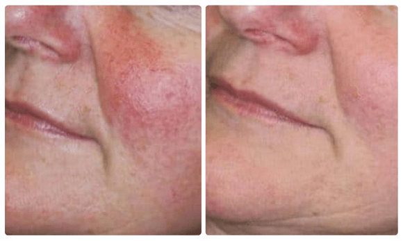 photos of woman's cheek before and after photo rejuvenation treatment