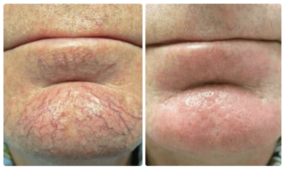photos of man's chin before and after photo rejuvenation treatment